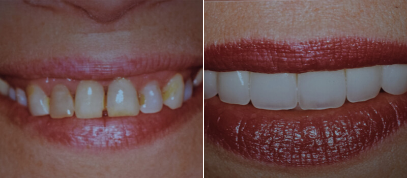 Cosmetic Dental Procedure Before and After image