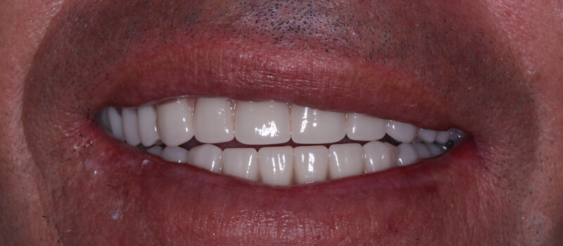 Dental Implants by dentist in Rockwall