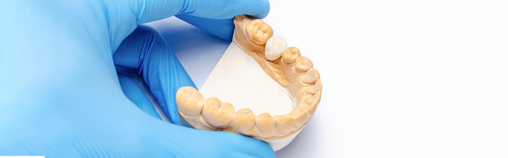 Top 5 Benefits of Dental Crowns