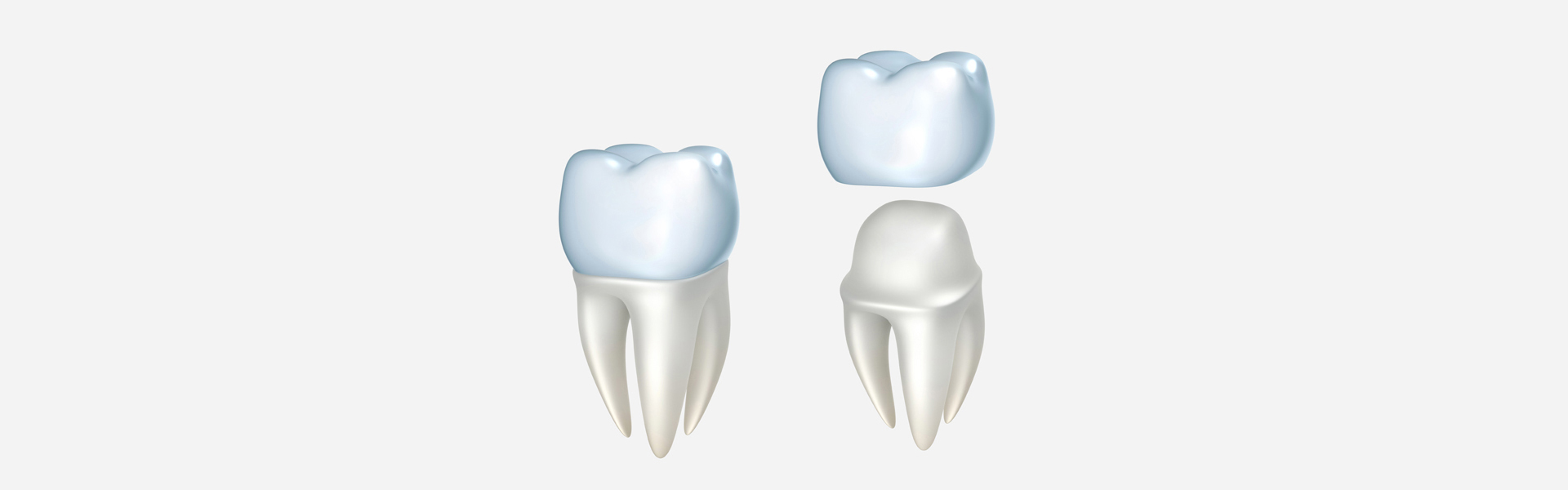 From Small Cavity to Big Problem: When to Consider a Crown